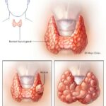 Nodular Goiter Linked to Papillary Thyroid Cancer: New Study