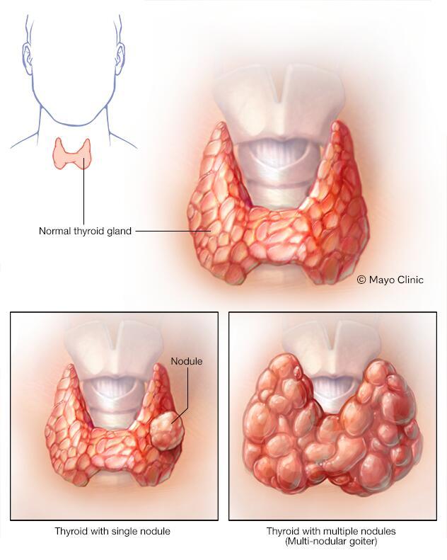 Nodular Goiter Linked to Papillary Thyroid Cancer: New Study