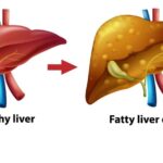 Steatotic Liver Disease: Gender Disparity in Serious Outcomes