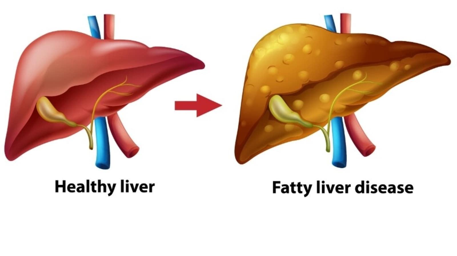 Steatotic Liver Disease: Gender Disparity in Serious Outcomes