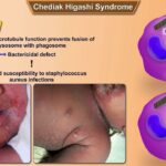 Chediak-Higashi Syndrome Diagnosed Through Morphology: A Case Report