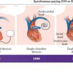 New Pacemakers Revolutionize Treatment at UMBAL Burgas