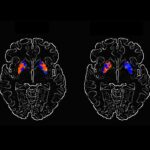 AI Breakthrough: New Biomarkers Identified for Early Alzheimer’s Detection