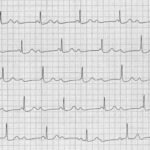 Complete Heart Block: When Patients Refuse Pacemakers – A Case Study