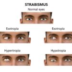 New Tool for Adult Strabismus Diagnosis: AS-20 Translation and Validation