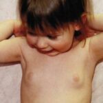 Premature Puberty: Causes and Risks for Children