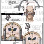 Cone Beam CT-Guided Stereotactic Radiotherapy for Recurrent Pancreatic Cancer: A Case Study