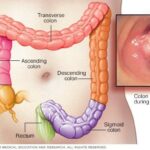 Colon Cancer: Silent Killer Claims 15 Lives Daily in Thailand