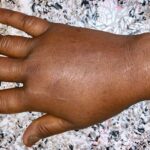 Painful, Swollen Fingers: Uncovering an Unexpected Cause