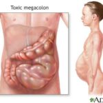 Explosive Colon Cancer Growth: Avoid These Foods for Prevention