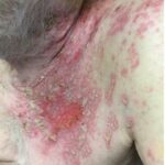 Atypical Painless Herpes Zoster in Elderly Male: A Case Report