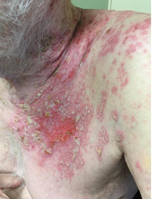 Atypical Painless Herpes Zoster in Elderly Male: A Case Report